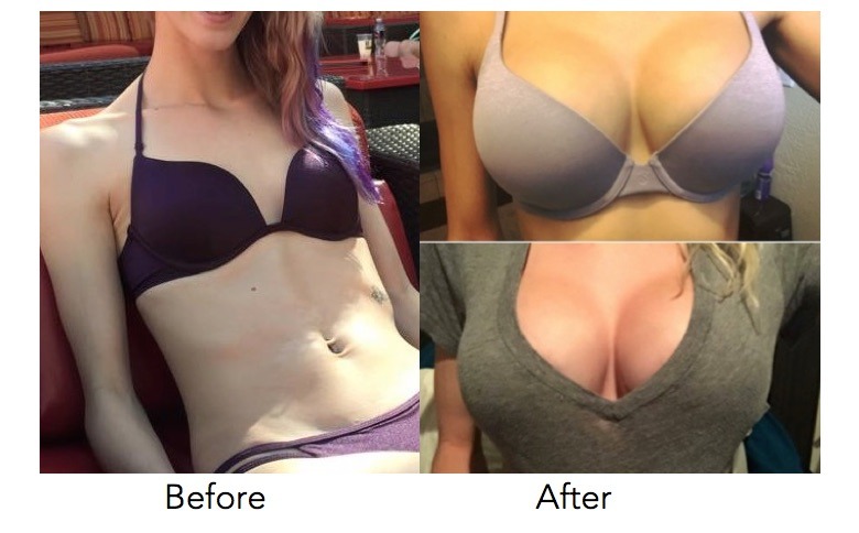 Dr. Erika Sato on X: This 33-year-old female patient underwent a  #BreastAugmentation using 415cc Sientra 106 Textured Round Moderate Plus  Profile Silicone Breast Implants. (713)799-8989   #DrErikaSato #Texas #TX #Makeover