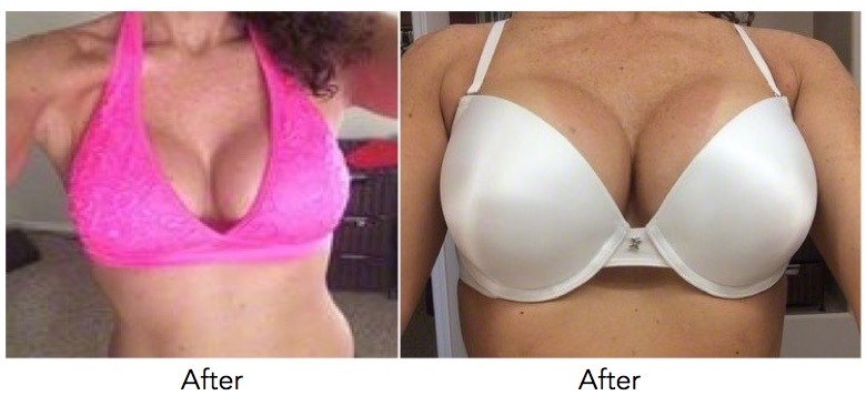 Extra Large Breast Augmentation Testimonial