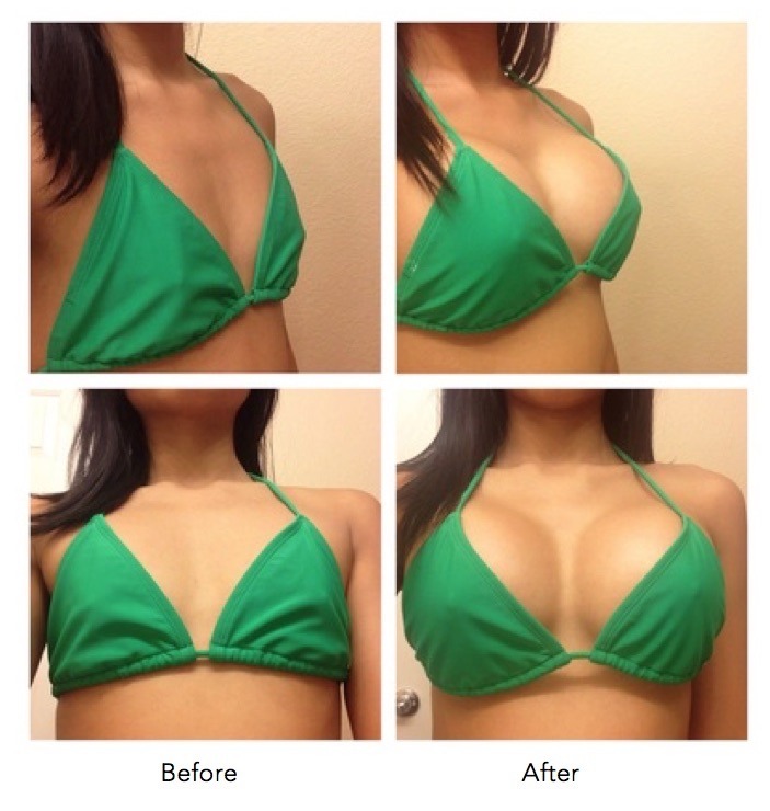 Breast Augmentation 415cc / 440cc Drop and Fluff Progress