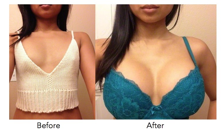 Dr. Erika Sato on X: This 33-year-old female patient underwent a  #BreastAugmentation using 415cc Sientra 106 Textured Round Moderate Plus  Profile Silicone Breast Implants. (713)799-8989   #DrErikaSato #Texas #TX #Makeover