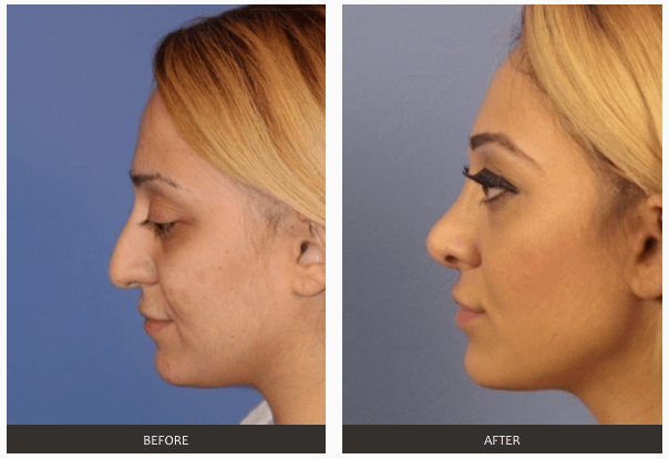 Nose Surgery | Rhinoplasty | Nose Job | Las Vegas NV | Lake Havasu
