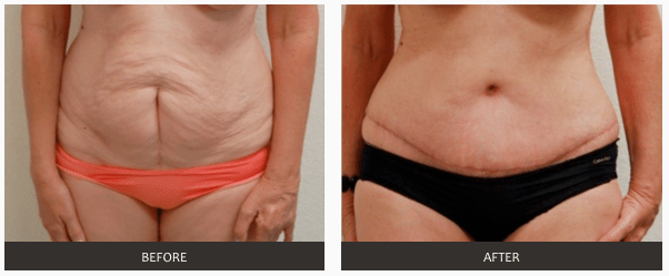 Tummy Tuck | Abdominoplasty | Plastic Surgeon | Las Vegas | Lake Havasu
