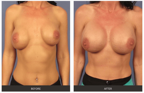 Breast Revision | Breast Implant | Breast Specialist | Las Vegas 