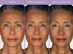 botox-before-and-after-pictures