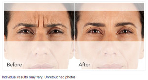 Xeomin Wrinkle Reduction Before After Photo