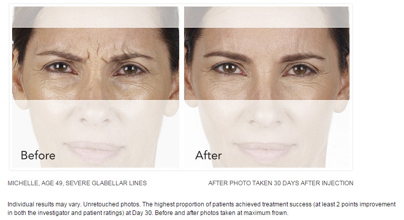 Xeomin Wrinkle Reduction Before After Photos