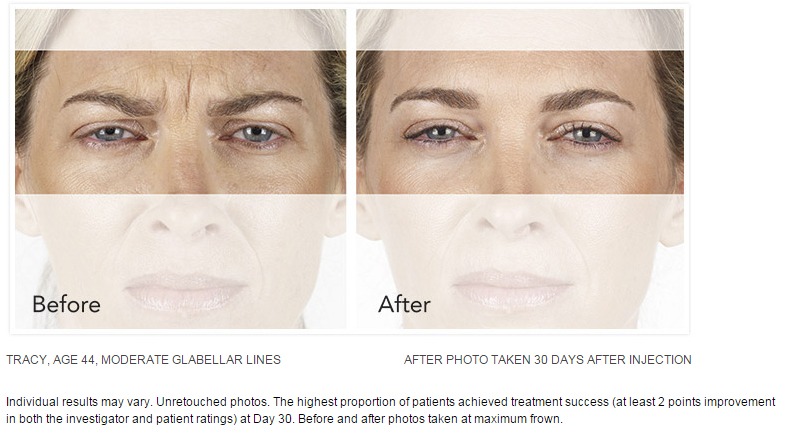 Xeomin Wrinkle Reduction Before After Picture