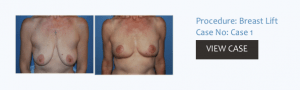 Cosmetic Surgery | Breast Lift | Mastopexy | Las Vegas NV