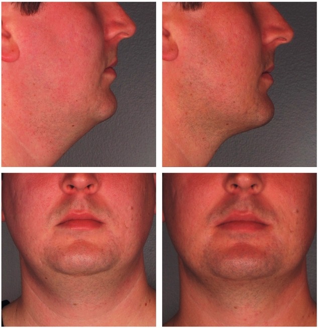 Kybella Injections for Double Chin Reduction Before After Photo