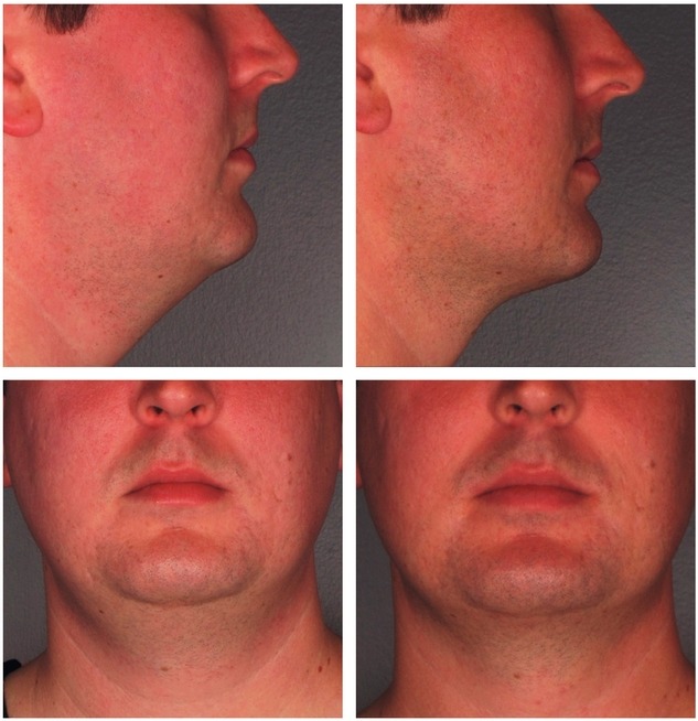 Kybella Injections, Double Chins, Photo