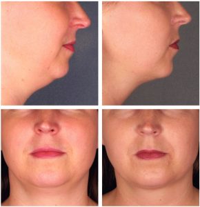 Kybella Injections for Double Chin Reduction Before After Photos