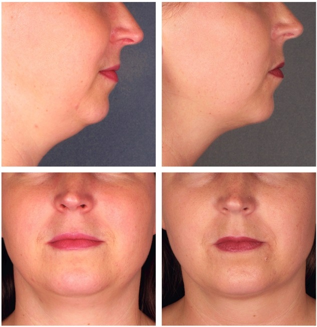 Chin Sculpting, Permanent Double Chin Removal