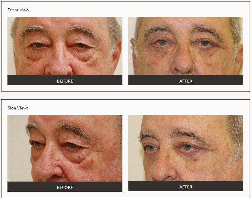 Las Vegas Eyelid sugery before after photos