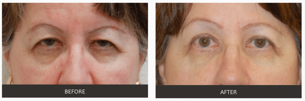 Blepharoplasty (Eyelid Surgery) Before and After Photos | Las Vegas
