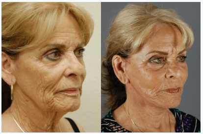 Facelift Before and After Photos, Las Vegas Plastic Surgery