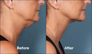 Kybella