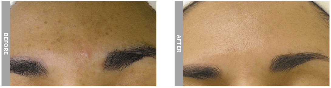 HydraFacial MD