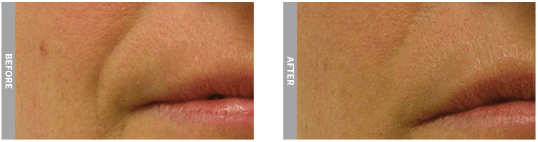 HydraFacial MD