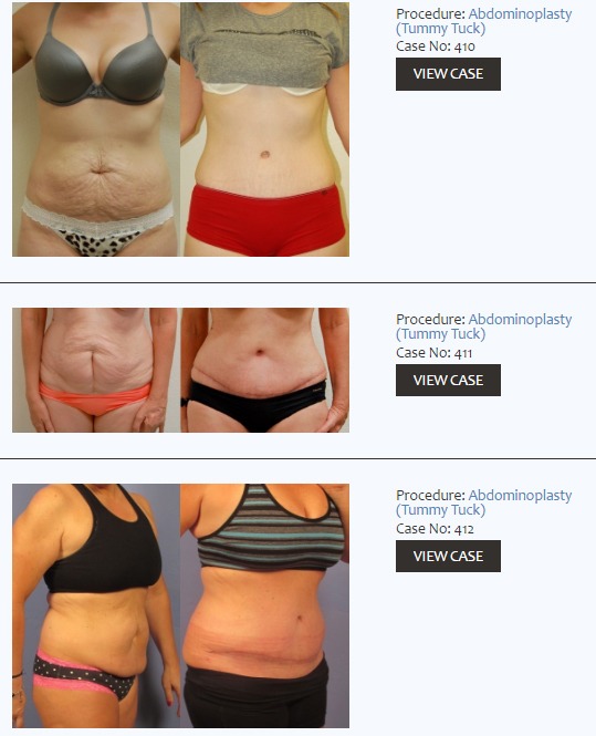 Dr. Zuckerman's Techniques to Achieve the Best Tummy Tuck Surgery