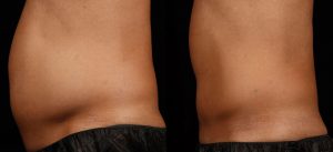 Reduce Love Handles With SculpSure Laser Treatment | Vegas Med Spa