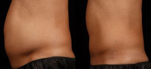 Love Handles Before and After Photos, Non-Surgical treatment for