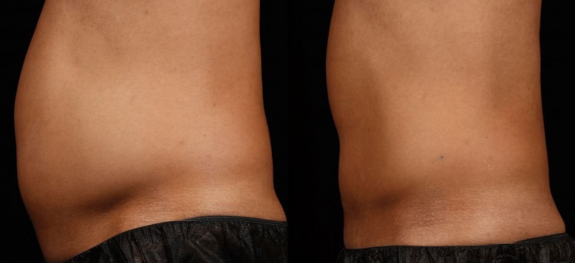 How to Get a Flat Tummy: Tummy Tuck vs. Liposuction vs. SculpSure