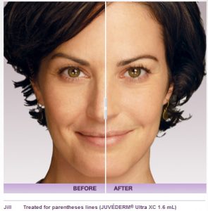 Non-Surgical Liquid Facelift With Dermal Fillers | Bullhead City | Vegas