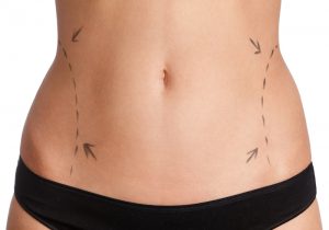 Body Contouring Plastic Surgery After Gastric Bypass | Las Vegas