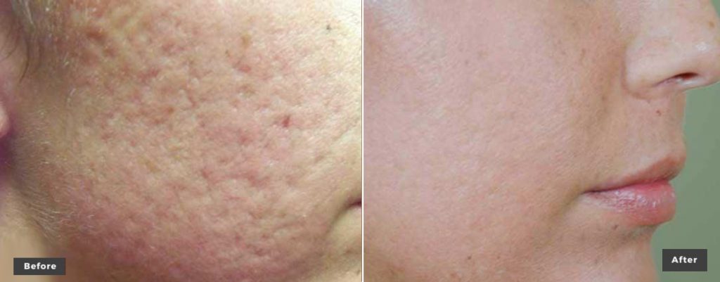 Skin Resurfacing Treatment Laser Genesis Skin Toning Scar Removal