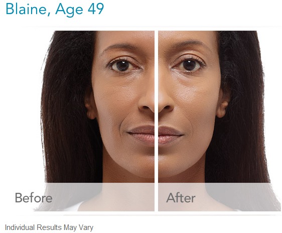 Radiesse Dermal Filler Can Help Fill In Laugh Line Wrinkles