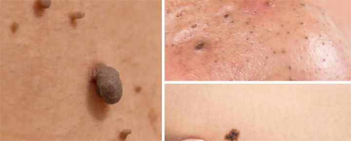 Shaving off a mole at home