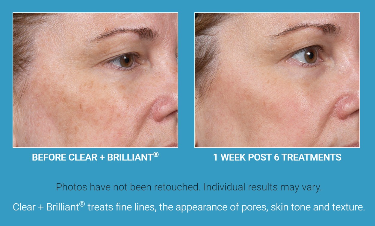 Clear And Brilliant Before And After Pores
