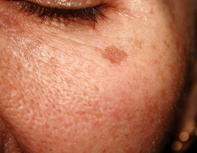 Sun Damage Laser Skin Treatment, Las Vegas Nevada