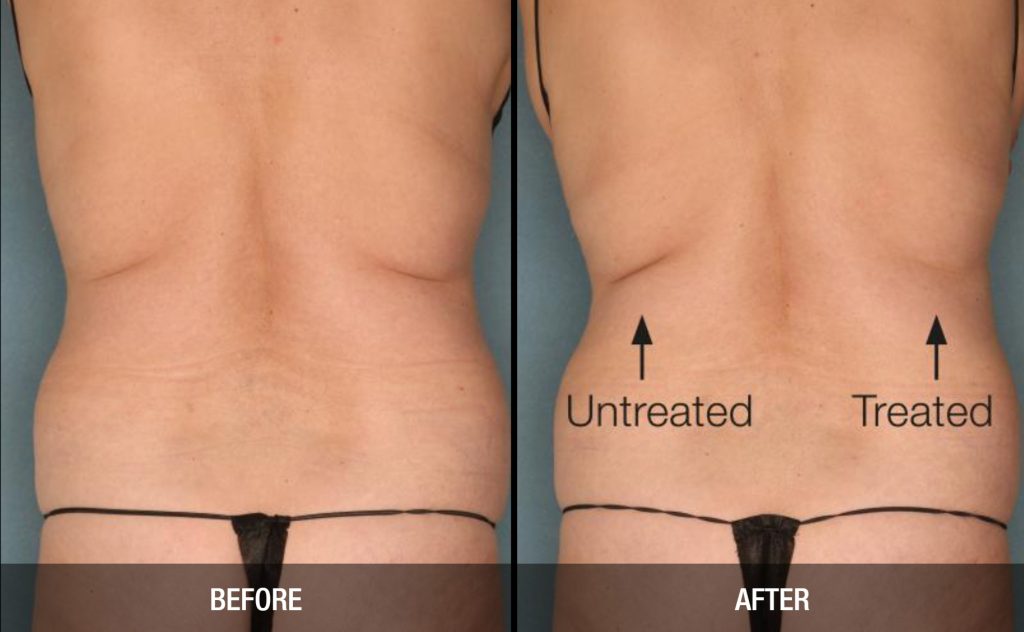 Neck Fat Removal with Velashape  Non-surgical body contouring