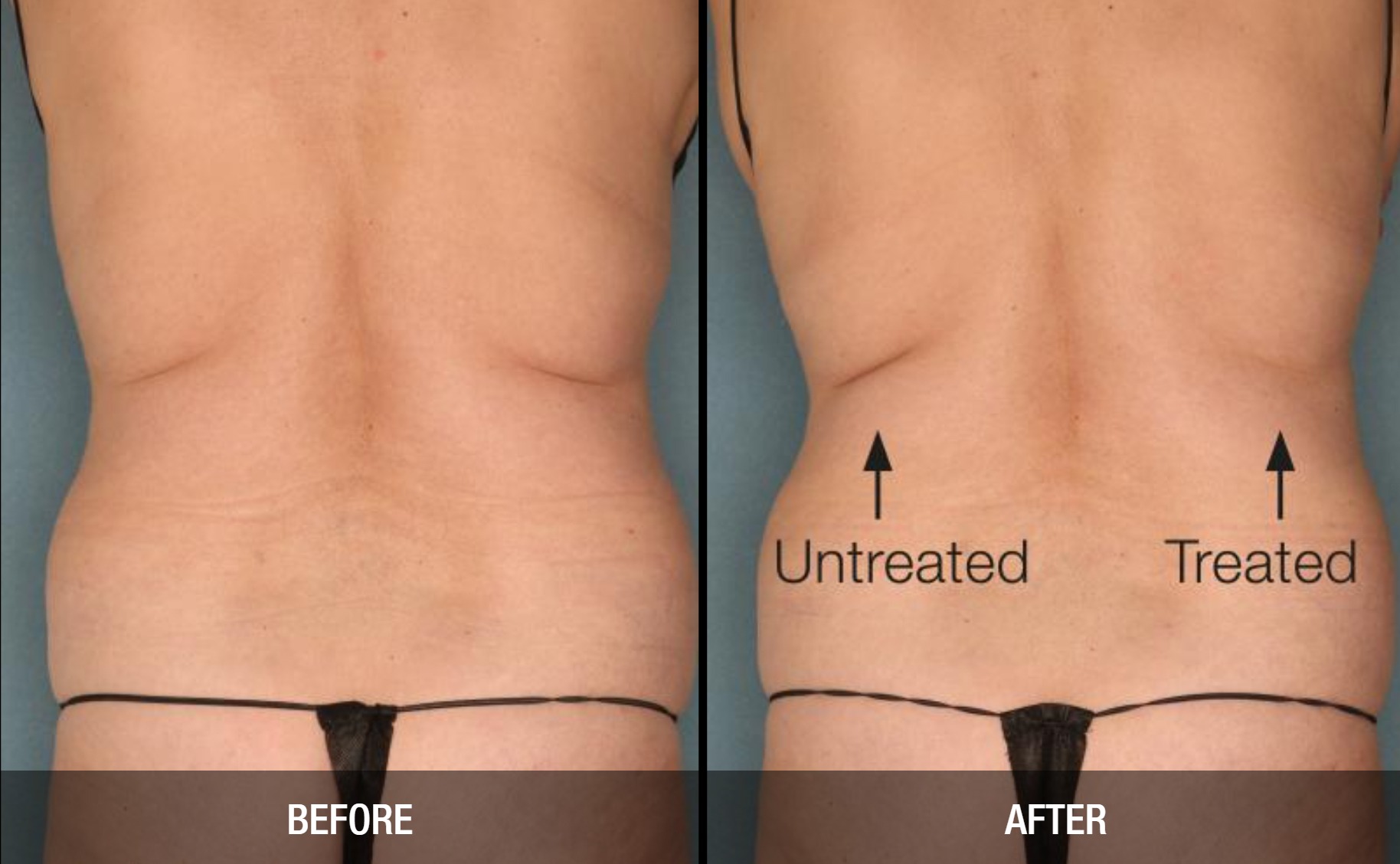 Flank Fat Removal with Velashape  Non-surgical Body Contouring Las Vegas NV