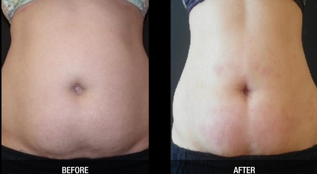 non surgical belly button lift