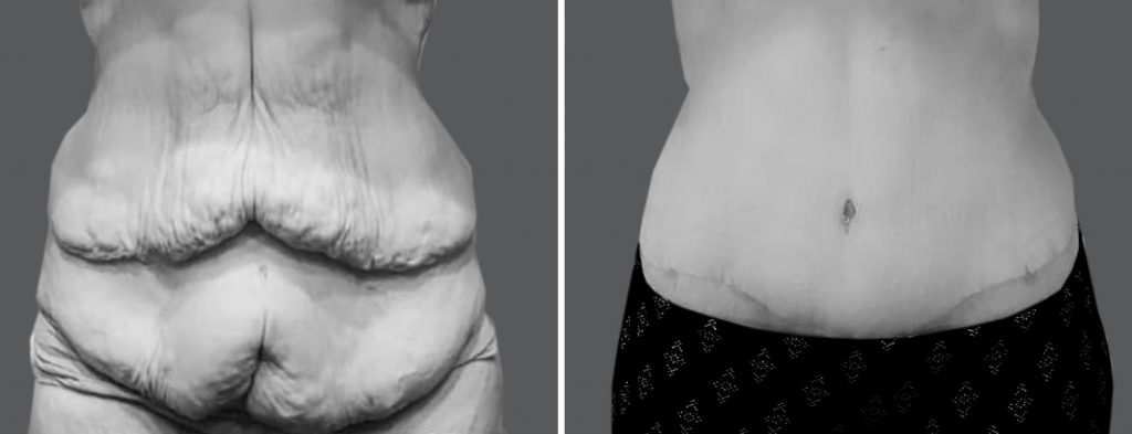 extreme weight loss skin removal surgery