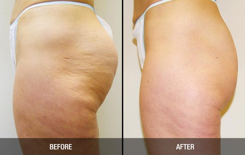 Plastic surgery treatments to eliminate cellulite