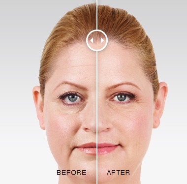 Nonsurgical Facelift Options For Facial Volume