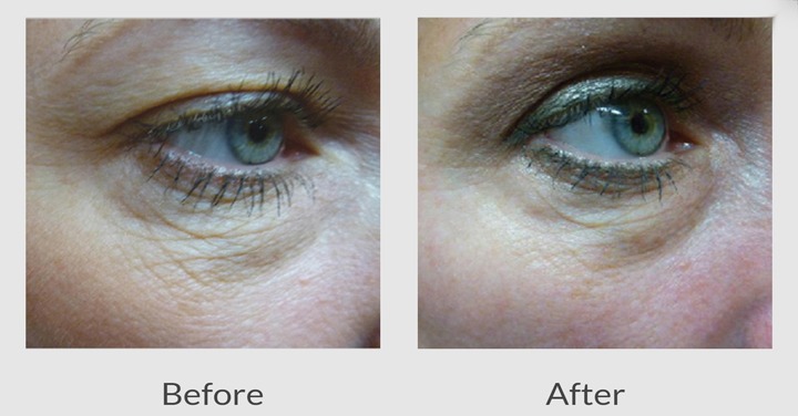 Nonsurgical Facelift Skin Tightening Reduce Aging