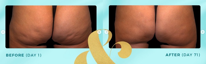 QWO Cellulite Treatment Before After Photos