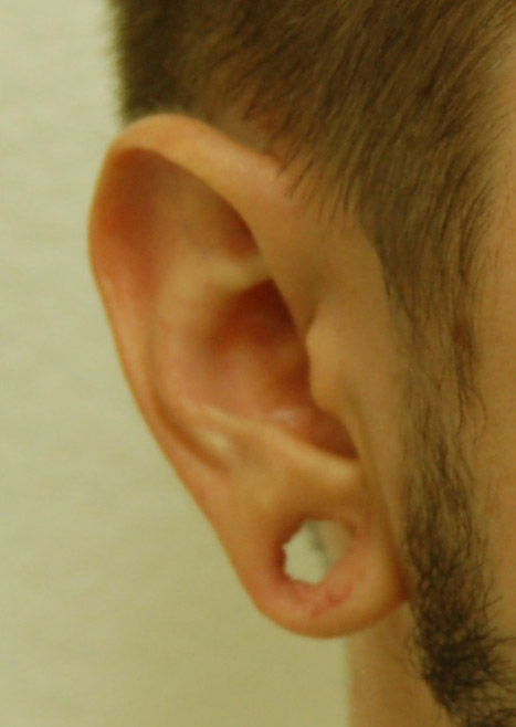 Otoplasty Ear Plastic Surgery Las Vegas | Cosmetic Surgeon Reshaping